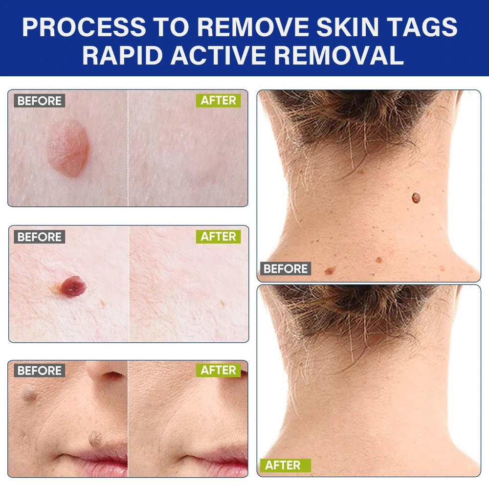 wart remover ointment